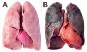 Perbandingan paru-paru sehat dan perokok
